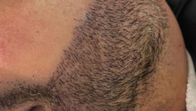 Transplante de barba cresce no mercado masculino