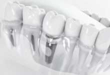 Implante zigomático traz nova alternativa na implantodontia