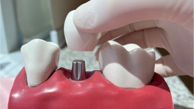 Cresce busca por implantes dentários com tecnologia digital